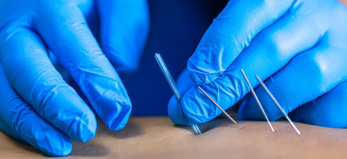 Acupuncture